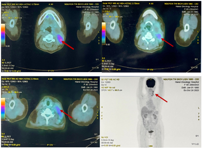 CASE LÂM SÀNG U LYMPHO KHÔNG HODGKIN