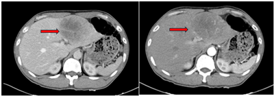 CASE LÂM SÀNG:  ĐIỀU TRỊ BỆNH NHÂN SARCOMA CƠ TRƠN HIẾM GẶP Ở GAN  TẠI TRUNG TÂM Y HỌC HẠT NHÂN VÀ UNG BƯỚU, BỆNH VIỆN BẠCH MAI