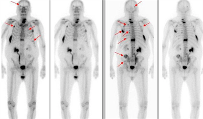 Điều trị giảm đau ung thư di căn xương bằng Strontium-89