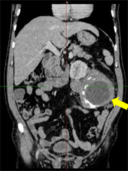 CASE LÂM SÀNG: CHẨN ĐOÁN VÀ ĐIỀU TRỊ U XƠ DẠNG GÂN (U DESMOID) SAU PHÚC MẠC TẠI TRUNG TÂM Y HỌC HẠT NHÂN VÀ UNG BƯỚU, BỆNH VIỆN BẠCH MAI