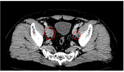 Case lâm sàng: Chẩn đoán ung thư tiền liệt tuyến tiến triển di căn phần mềm, xương  tại Trung tâm Y học hạt nhân và Ung bướu Bệnh viện Bạch Mai